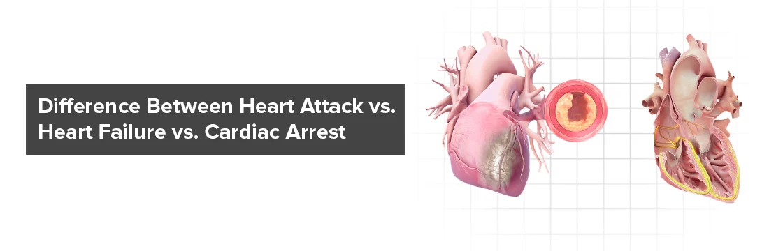  Difference Between Heart Attack vs. Heart Failure vs. Cardiac Arrest